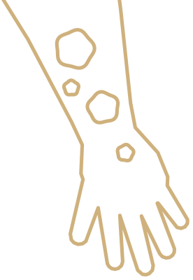 Eccema numular