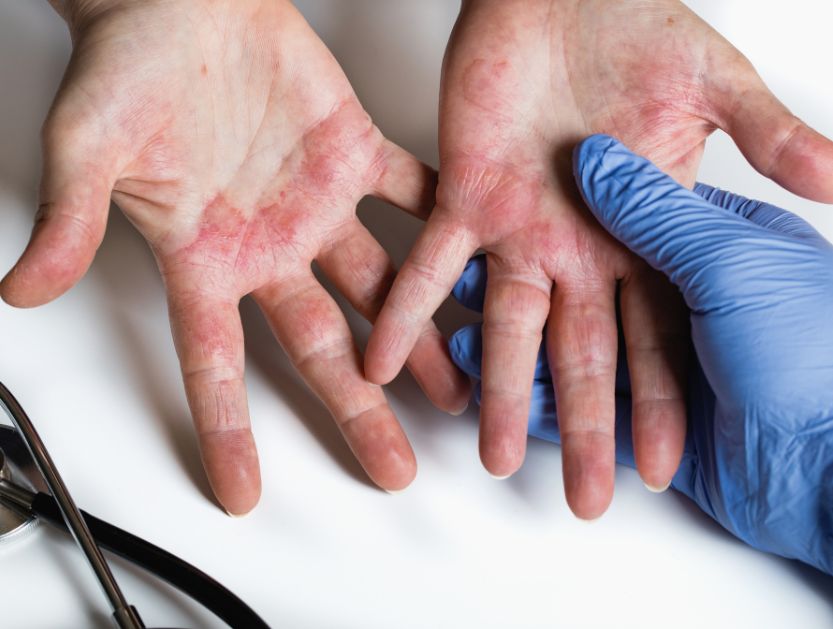 Dermatitis atópica moderada-grave Dermatitis atópica moderada-grave