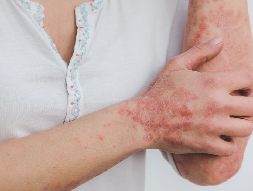 Psoriasis moderada-grave en mayores de 40 años Psoriasis moderada-grave en mayores de 40 años